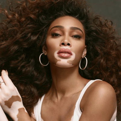 Winnie Harlow